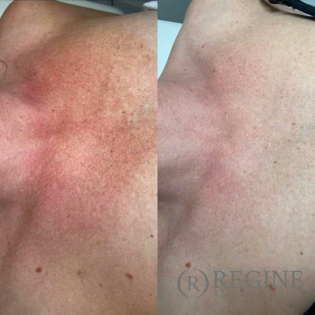 Pigmentation spots / rosacea / small facial veins BBL - Regine Esthétique